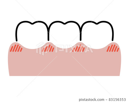 牙齦和牙齒紅腫 83156353