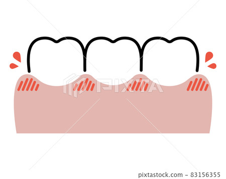 牙齦和牙齒腫脹和出血 83156355