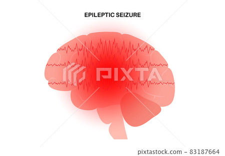 epilepsy seizure concept 83187664