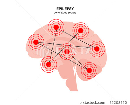 epilepsy seizure concept 83208550