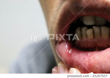 Close-up of a person with mouth ulcer Close-up of a person with mouth ulcer 83267837