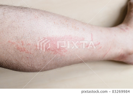 side of male shin with itchy red rash 83269984