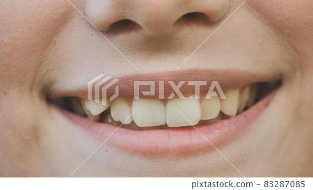 A young girl smiles and shows her crooked teeth. 83287085
