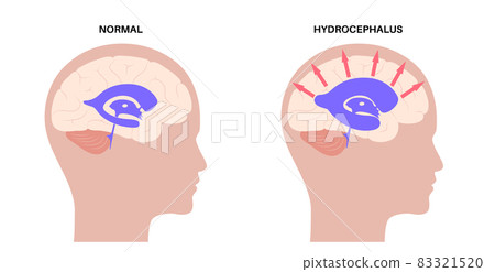 Ventricular system concept Ventricular system concept 83321520