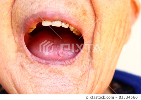 Bad breath and denture grandma 83334560