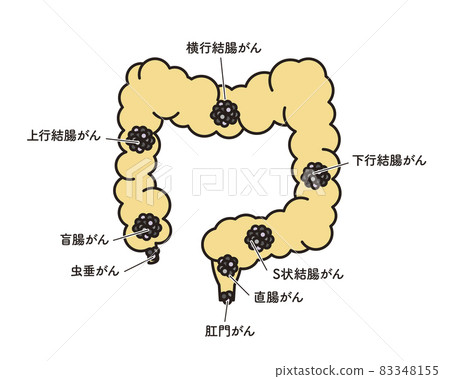 Simple illustration: Cancer site of the large intestine 83348155