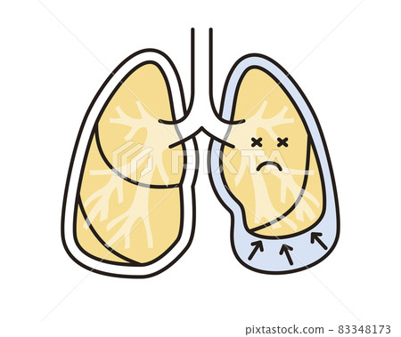 Simple illustration pleural effusion lung 83348173