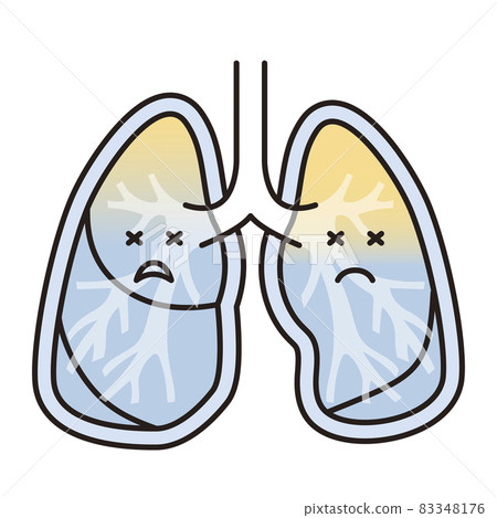 Simple illustration: Pulmonary edema lung 83348176