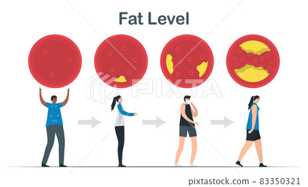 Cholesterol level. Layers of fat in blood vessel. Strong person becomes weak person. Cardiology vector illustration isolated on white background. Cholesterol level. Layers of fat in blood vessel. Strong person becomes weak person. Cardiology vector illustration isolated on white background. 83350321