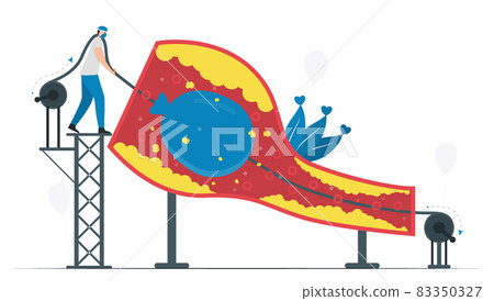 This disease is narrowing of coronary arteries. Balloon angioplasty uses to improve blood flow of vessel. Cardiology vector illustration. This disease is narrowing of coronary arteries. Balloon angioplasty uses to improve blood flow of vessel. Cardiology vector illustration. 83350327