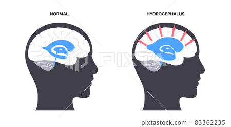Ventricular system concept 83362235