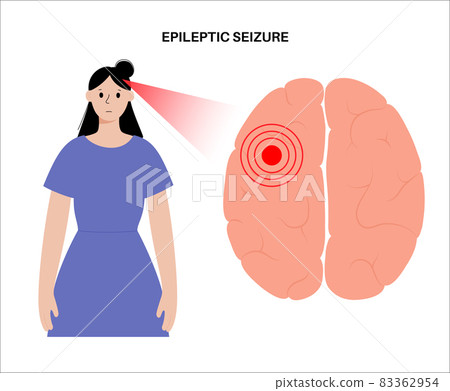 epilepsy seizure concept 83362954