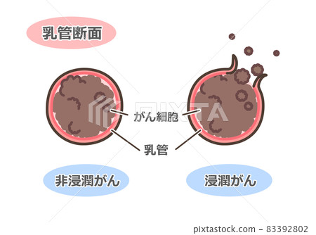乳腺癌導管橫截面 83392802