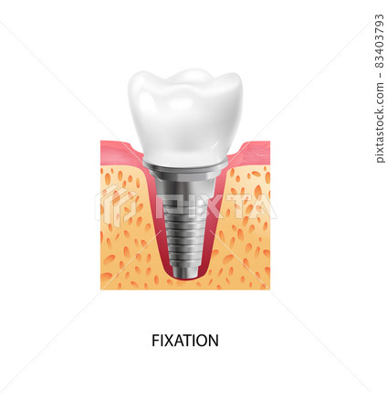 Dental Implantation Fixation Composition Dental Implantation Fixation Composition 83403793