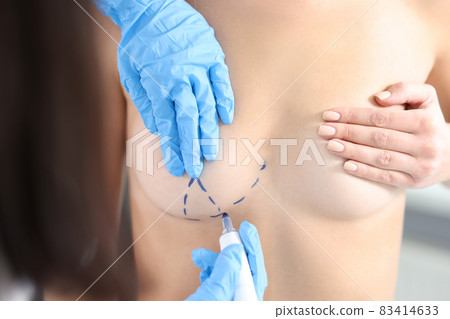 Plastic surgeon drawing preoperative markings on patient chest closeup Plastic surgeon drawing preoperative markings on patient chest closeup 83414633