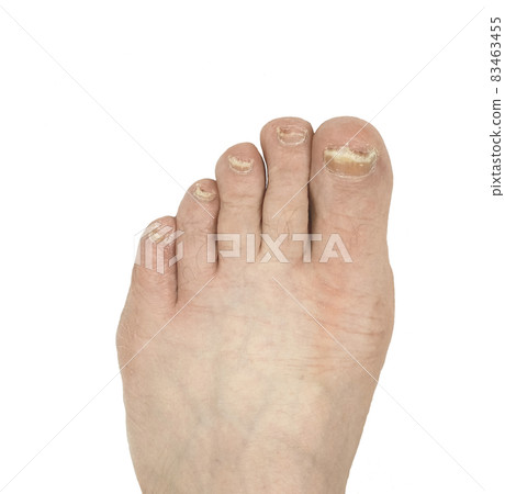Nail fungus. The foot of a man's leg, with nails diseased with fungus. Isolated image on white background Nail fungus. The foot of a man's leg, with nails diseased with fungus. Isolated image on white background 83463455