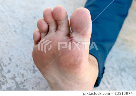 Men's toe fungal infection with selective focus 83513974