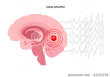 epilepsy seizure concept 83525236