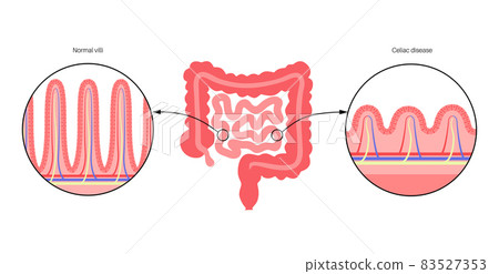 Celiac disease inflammation 83527353