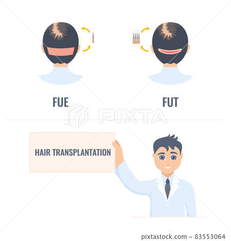 Hair transplantation infographics of female alopecia treatment 83553064