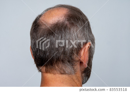 A closeup of a half-bald male head, hair transplant concept for hair loss A closeup of a half-bald male head, hair transplant concept for hair loss 83553518