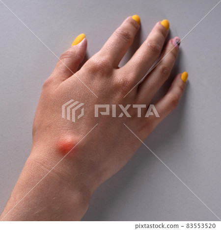 Ganglion cyst on woman hand on white background 83553520
