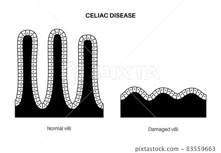 Celiac disease inflammation 83559663
