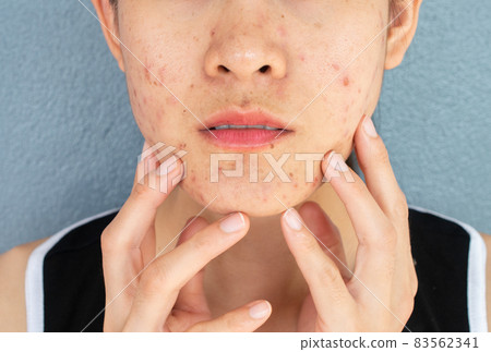 Close-up of worrying woman half face with problems of acne inflammation (Papule and Pustule) on her face. Conceptual of problems on woman skin. Close-up of worrying woman half face with problems of acne inflammation (Papule and Pustule) on her face. Conceptual of problems on woman skin. 83562341
