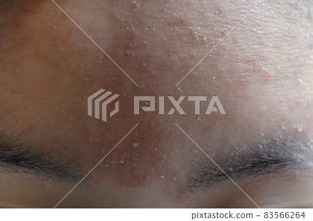 woman with symptom of atopic dermatitis on Forehead. woman with symptom of atopic dermatitis on Forehead. 83566264