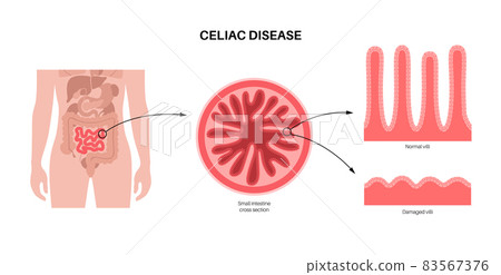 Celiac disease inflammation - Stock Illustration [83567376] - PIXTA