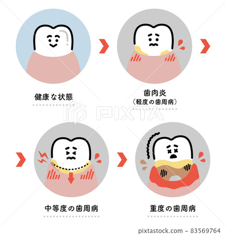 牙周病的進展 插圖集 (日文版) 83569764