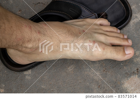 allergic reactions to tick bites 83571014