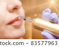 Lip augmentation treatment hyaluron pen device 83577963