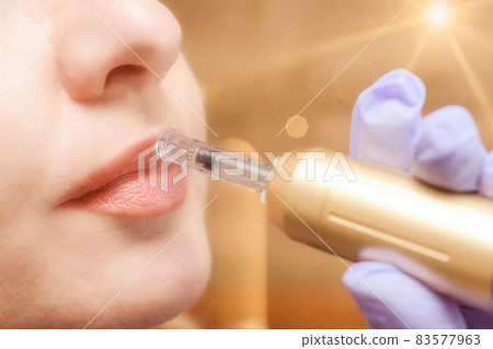 Lip augmentation treatment hyaluron pen device Lip augmentation treatment hyaluron pen device 83577963