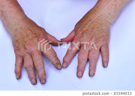 Two female hands damaged by arthrosis. Two female hands damaged by arthrosis. 83594013