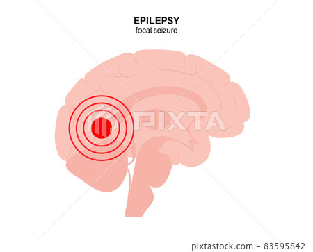 epilepsy seizure concept 83595842