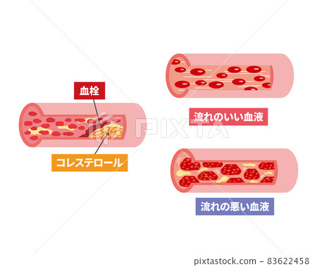 血管問題的橫截面圖像 83622458