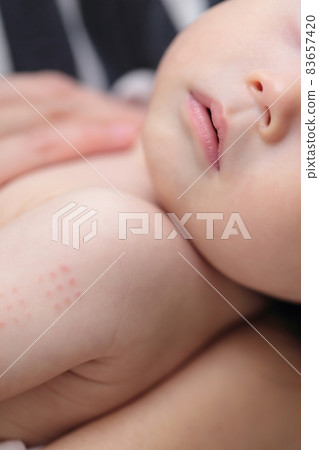 BCG vaccination injection marks on baby's arm BCG vaccination injection marks on baby's arm 83657420