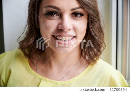 Beautiful girl smiling looking at camera, white teeth with braces. Dental care. Beauty woman smile with orthodontic accessories. Cosmetic dentistry, orthodontic treatment. Beautiful girl smiling looking at camera, white teeth with braces. Dental care. Beauty woman smile with orthodontic accessories. Cosmetic dentistry, orthodontic treatment. 83700294