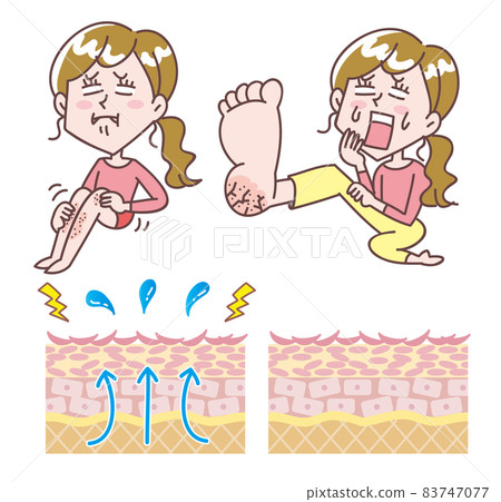 A set of skin cross sections with women suffering from dry skin 83747077