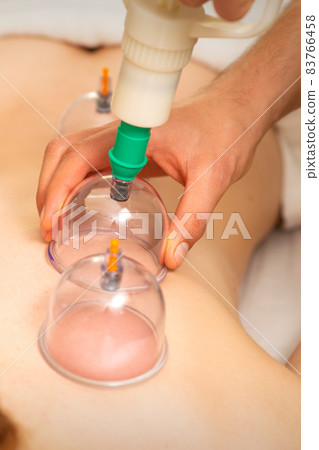 Acupuncture woman therapist placing the cup on the back of a female patient. Acupuncture woman therapist placing the cup on the back of a female patient. 83766458