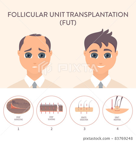 FUT hair transplantation procedure medical infographic poster FUT hair transplantation procedure medical infographic poster 83769248