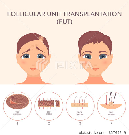 FUT hair transplantation procedure medical infographic poster 83769249