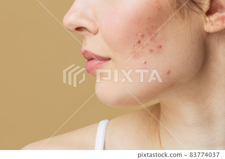 A young woman with bad skin. Skin with a lot of pimples. Acne disease, acne treatment. 83774037
