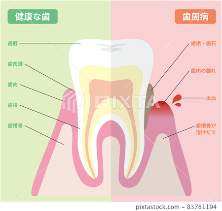 Illustrated healthy teeth and periodontal teeth Illustrated healthy teeth and periodontal teeth 83781194