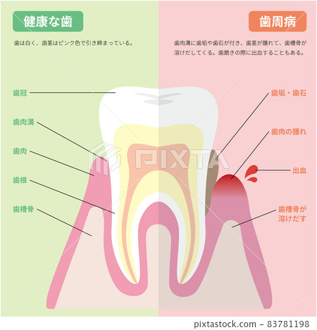 Illustrated healthy teeth and periodontal teeth (with explanation) Illustrated healthy teeth and periodontal teeth (with explanation) 83781198