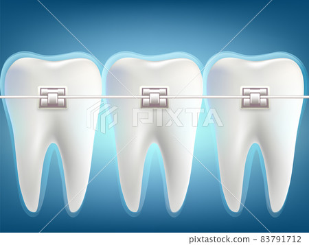 Metal braces on the teeth. 83791712