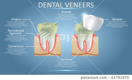 Dental veneers diagram, vector educational poster, diagram 83791970