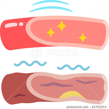 Supple blood vessels and hardened blood vessels - Stock Illustration ...