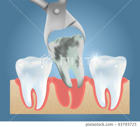 Tooth extraction vector medical poster design template Tooth extraction vector medical poster design template 83793725